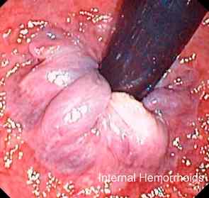 hemorrhoids colonoscopy